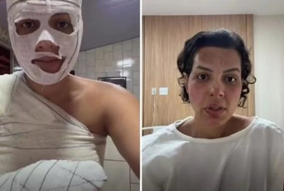 nutricionista-tem-33%-do-corpo-queimado-apos-explosao-de-saco-de-lixo…